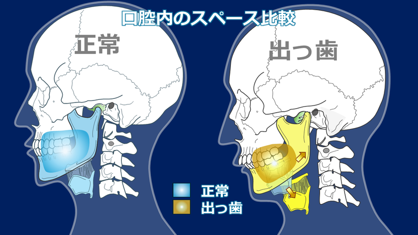 出っ歯では顎が後ろに下がったため、舌のスペースが無くなり、舌骨と甲状軟骨が下後方に移動