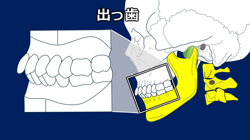 出っ歯では咬合平面が後ろ上がりになっているケースが多い