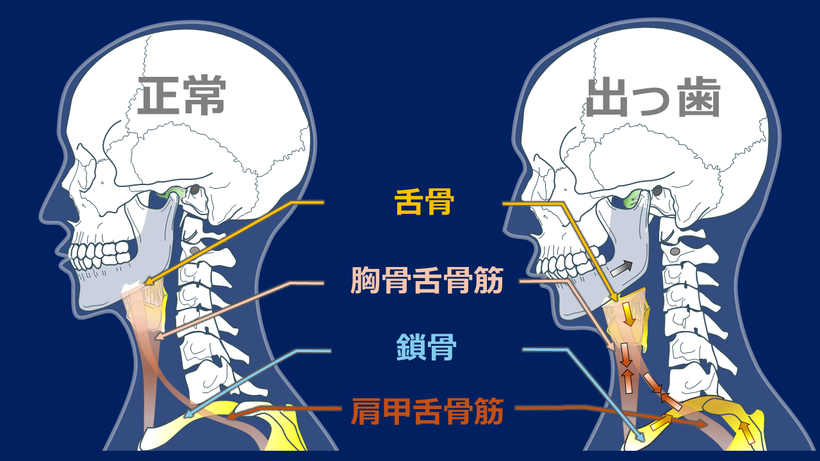 顎が後ろにずれると舌骨、甲状軟骨が、頬骨舌骨筋によって下に引かれ、下に移動し、鎖骨が頬骨を通じで後ろに引かれる。肩甲舌骨筋の緊張で舌骨と甲状軟骨は後ろに引かれ、肩甲骨が前方に引かれ、胸郭が狭くなり、呼吸が苦しくなる。