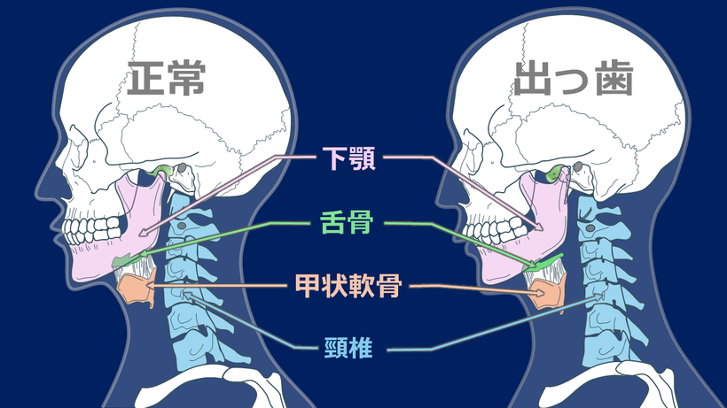 顎がズレることでリバースネックに、舌骨、甲状軟骨のが前下方に移動、喉元が膨らむ