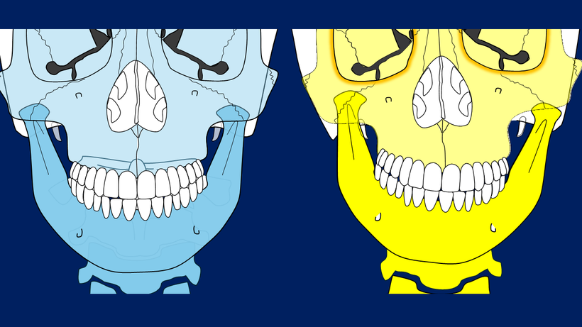 顎が左右に歪むとき、ゆがんだ側の顎関節が上奥に入る