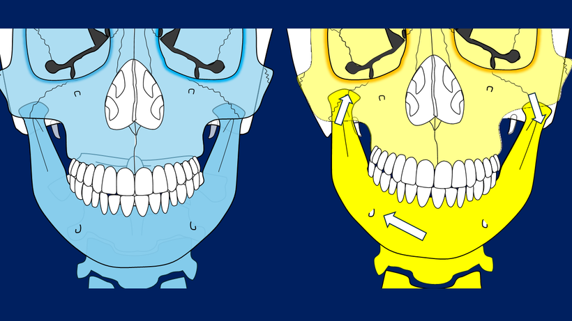 顎が左右に歪むとき、ゆがんだ側の顎関節が上奥に入る