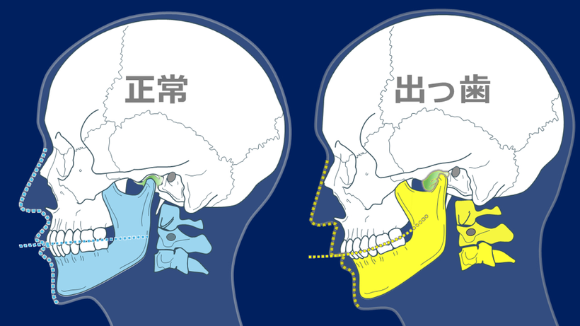 顎が後ろに下がって出っ歯になる場合、スピーの湾曲もつきます。左正常なものを湾曲が強いものを比較しました。