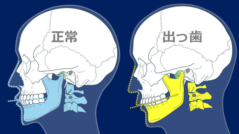 咬合平面が後ろ上がり、だと顎が後ろに移動して出っ歯に