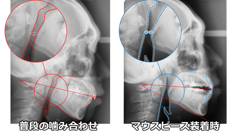 左は普段噛んでいるときのセファロレントゲン写真、右は顎を前に出した状態で撮影したもの、気道の広さが違っているのが分かる