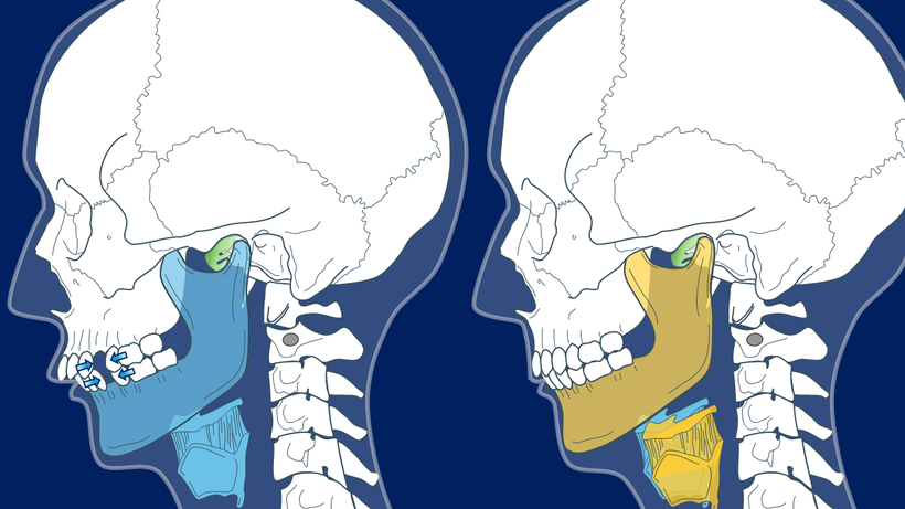 抜歯をすると前歯と臼歯がともに引き合う