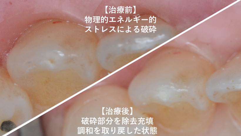 犬歯のわずかに砕けた部分（左上）を修復（右下）します。
