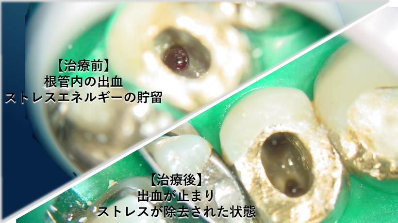 根管内から出血している状態（左上）から希嶺に汚れが取り除かれ、ストレスが解放された根の状態（右下）
