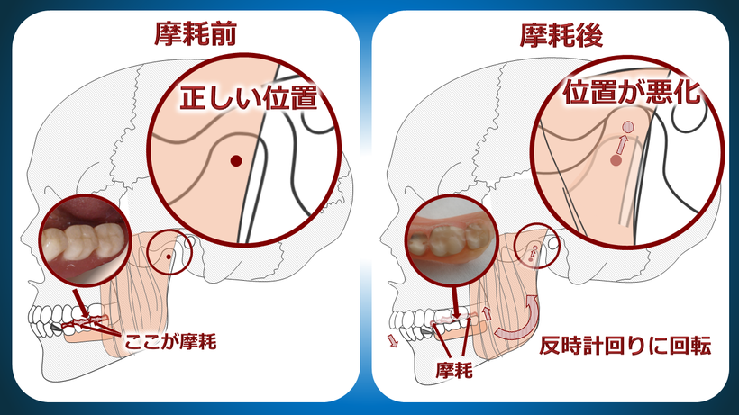 入れ歯の歯の摩耗や土手の吸収で噛み合わせが変化し、顎がズレます。定期的な裏打ち、歯の交換が必要です