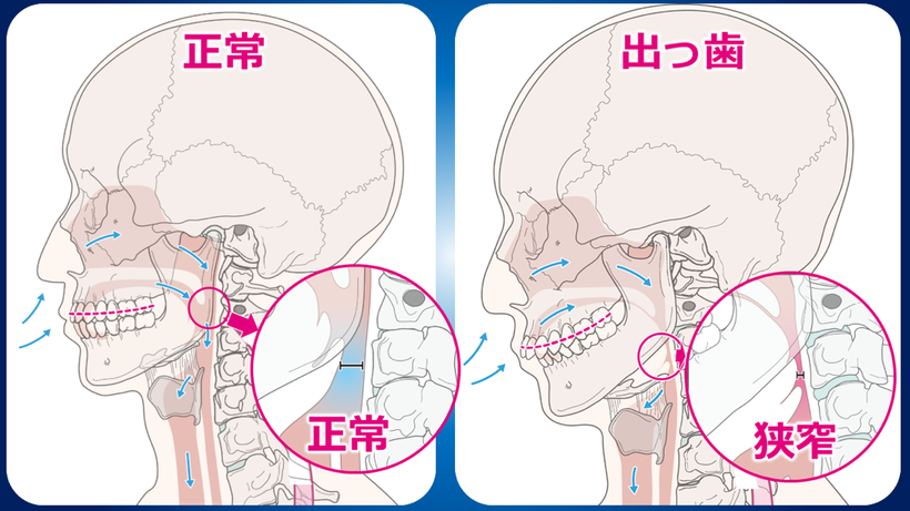 出っ歯による顎が後ろに下がり、呼吸の質が落ちます。拡大円のように、出っ歯で極端に呼吸路が狭くなる事があります。