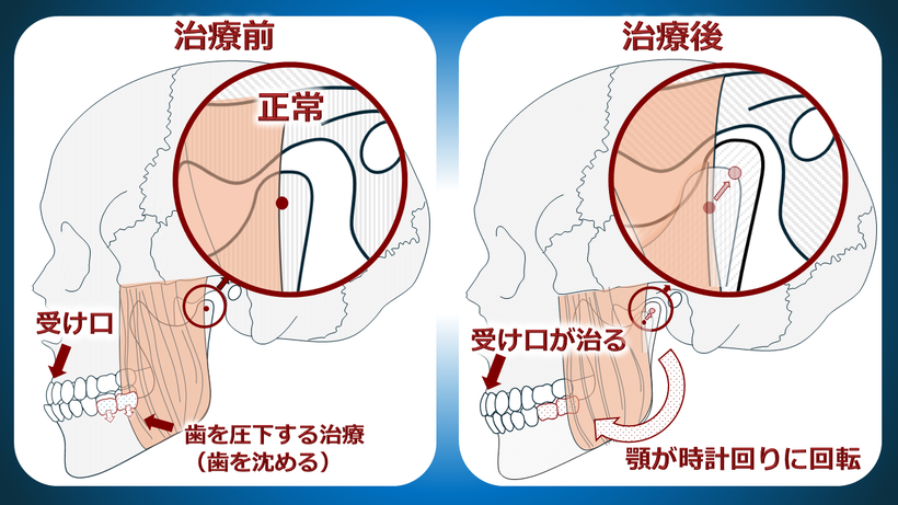 矯正治療で顎がズレ、全身の歪の原因になったケース