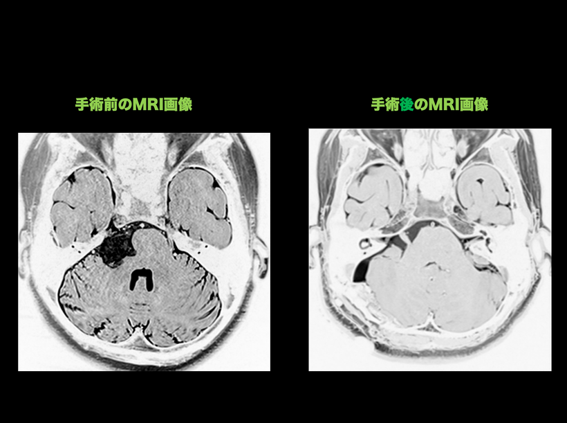 類上皮腫、類表皮腫、類表皮嚢胞の手術前後の頭部MRI画像