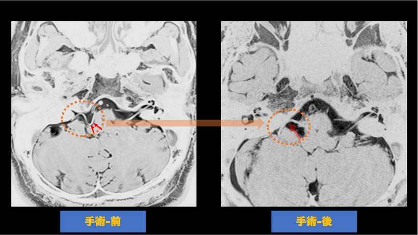 舌咽神経痛の術前後の頭部MRI画像の比較；手術により舌咽神経を圧迫していた血管が移動されている術前後のMRI画像の比較。