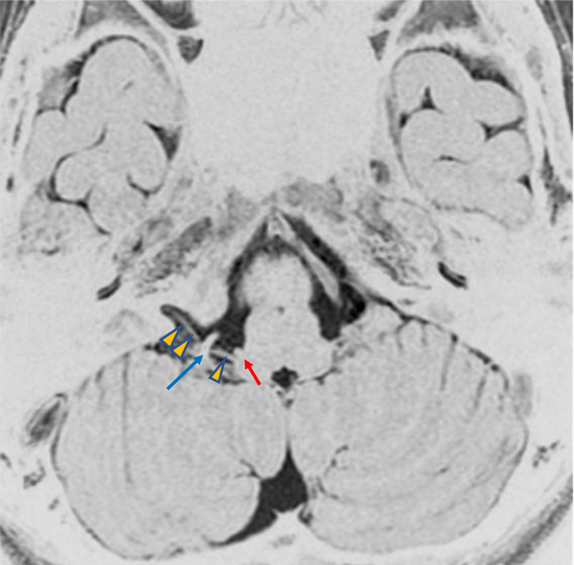 舌咽神経痛での頭部MRI画像；血管が舌咽神経を明らかに強く圧迫されているのがわかりやすい画像