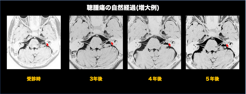 聴神経腫瘍の自然経過を示す頭部MRI画像（増大）