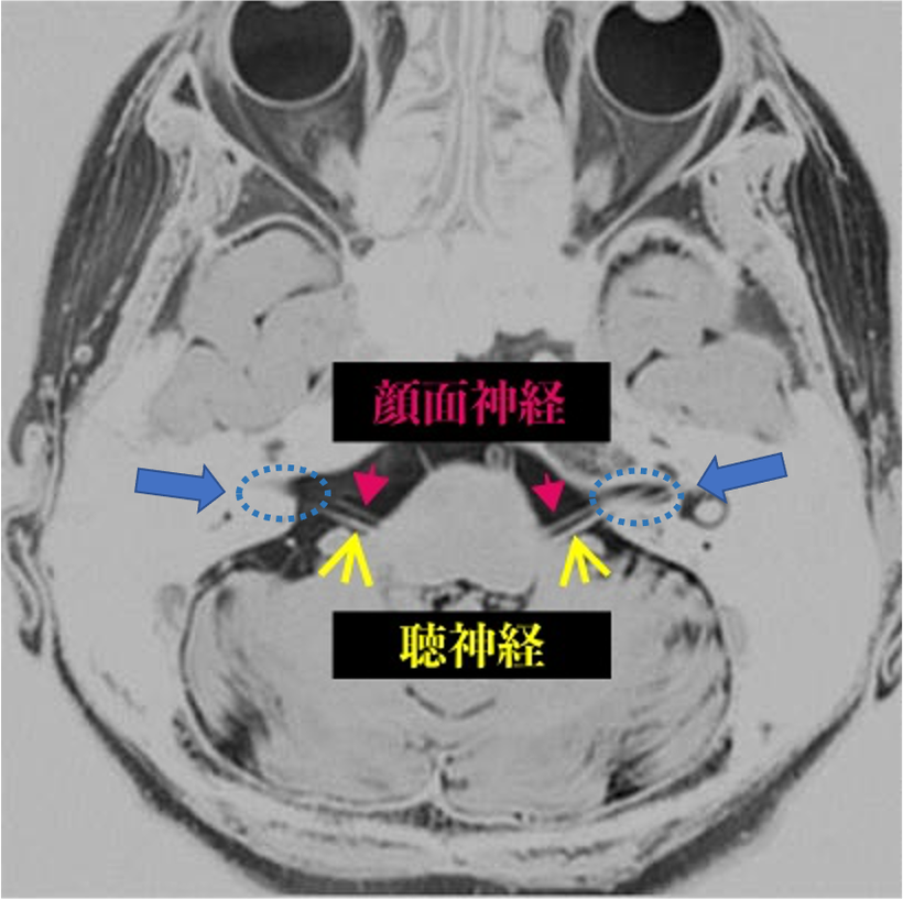 聴神経腫瘍の発生する聴神経の場所がわかる頭部MRI画像