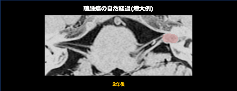 聴神経腫瘍の自然経過を示す頭部MRI画像（増大）；３年後