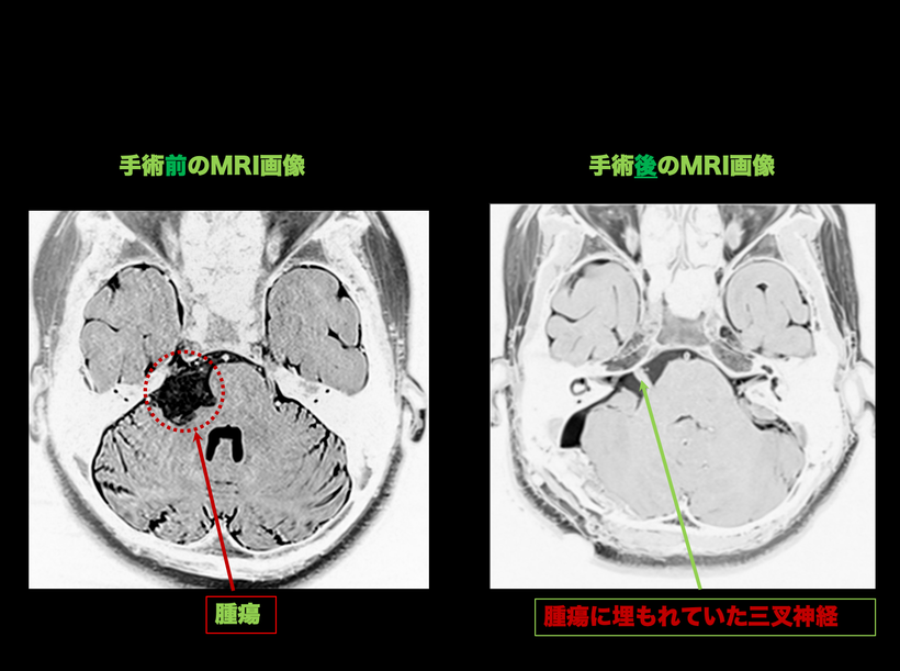 類上皮腫、類表皮腫、類表皮嚢胞の手術前後の頭部MRI画像（腫瘍の場所と三叉神経の位置を詳細に說明）