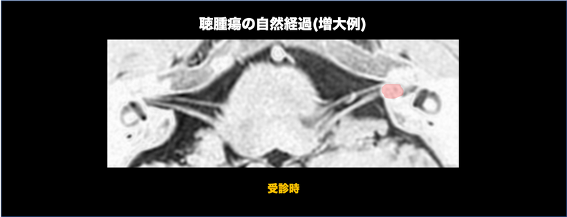 聴神経腫瘍の自然経過を示す頭部MRI画像（増大）；受診時