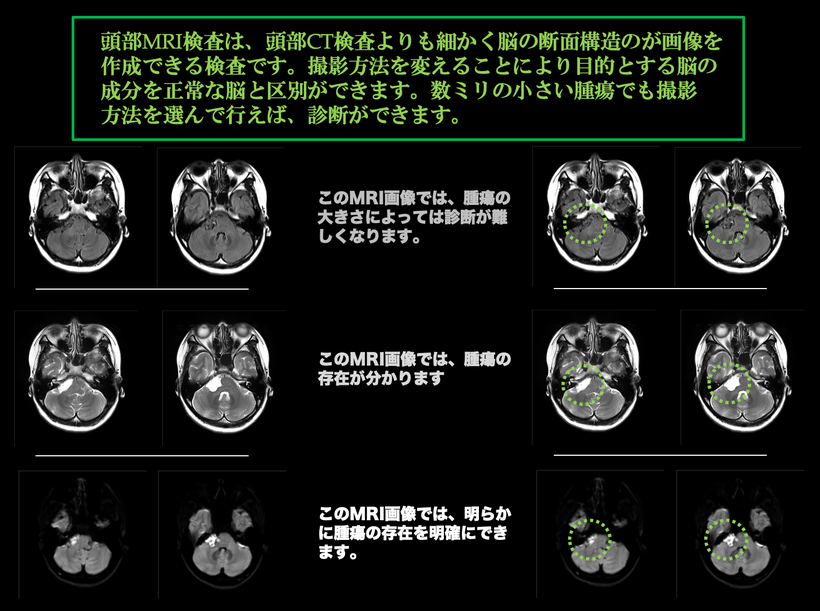 類上皮腫、類表皮腫、類表皮嚢胞の頭部MRI画像