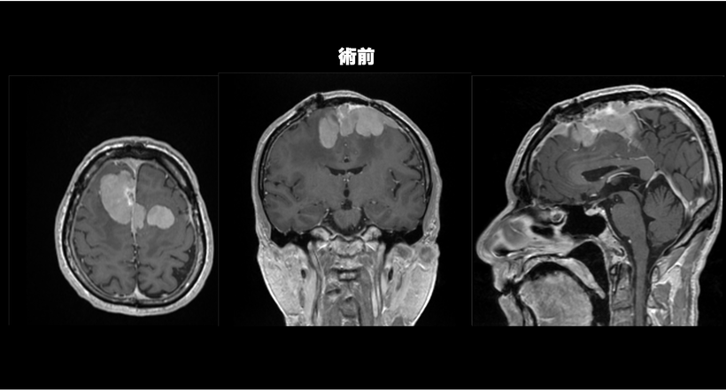 多発性髄膜腫の症例のMRI画像２の術前の画像