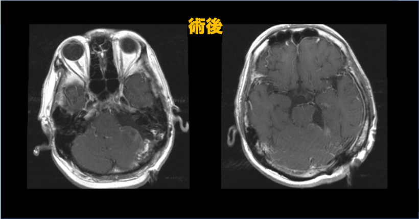 歩行障害にて車椅子で来院した後頭蓋窩髄膜腫の３６歳男性の症例　術後の頭部MRI画像