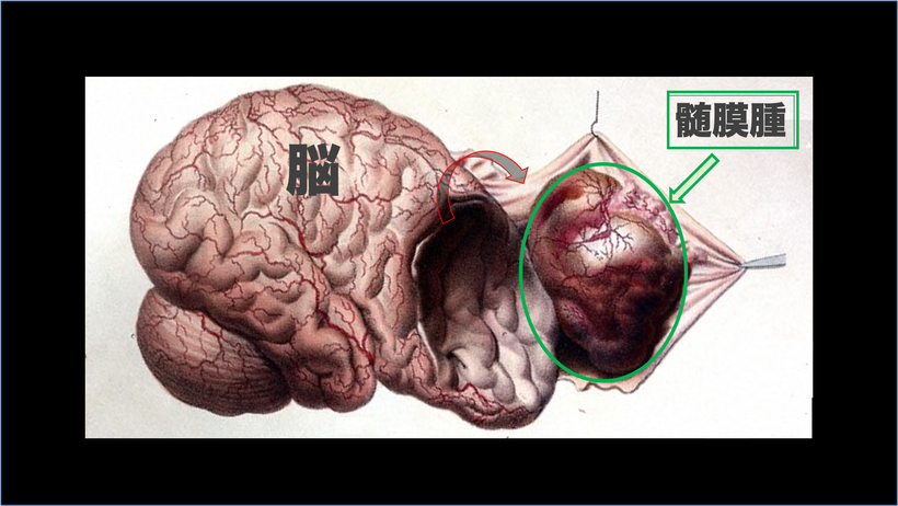わかりやすい髄膜腫と脳の関係を示したイラストです。