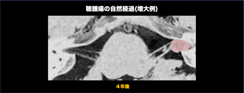 聴神経腫瘍の自然経過を示す頭部MRI画像（増大）；４年後