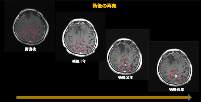 多発性髄膜腫の症例のMRI画像２の術後の再発画像