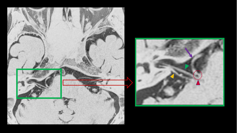頭部MRI画像で確認できる血管による顔面神経への圧迫（拡大画像を含む）pattern１