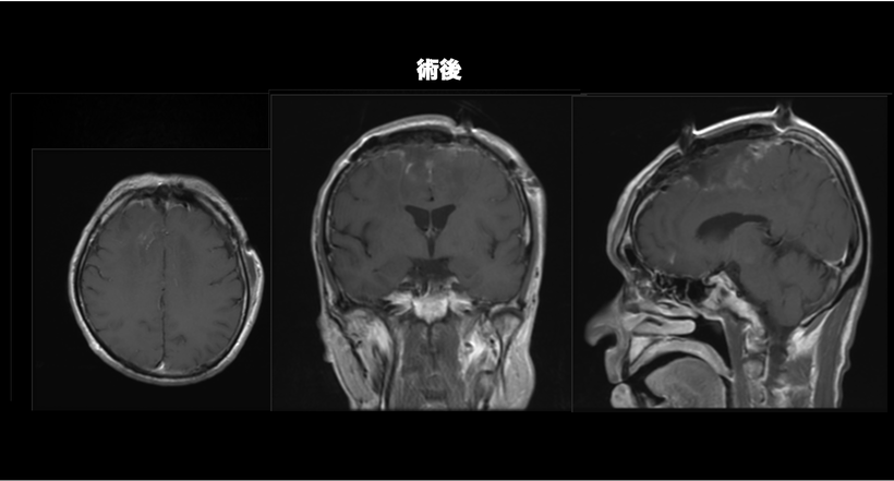 多発性髄膜腫の症例のMRI画像２の術後の画像