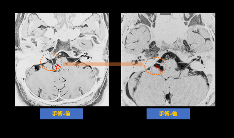 舌咽神経痛の術前後の頭部MRI画像の比較；手術により舌咽神経を圧迫していた血管が移動されている術前後のMRI画像の比較。