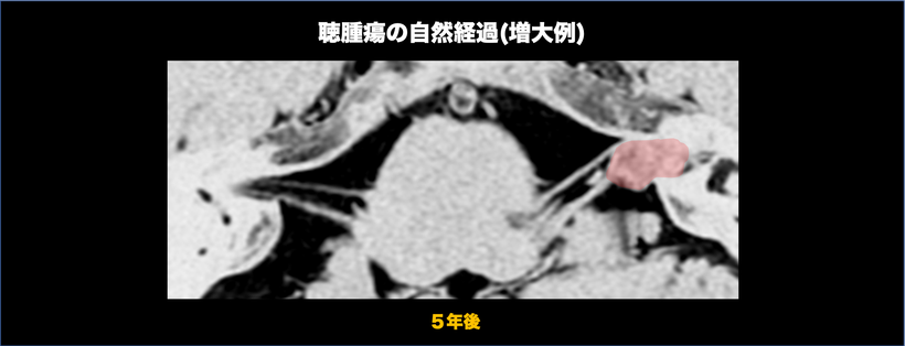 聴神経腫瘍の自然経過を示す頭部MRI画像（増大）；６年後