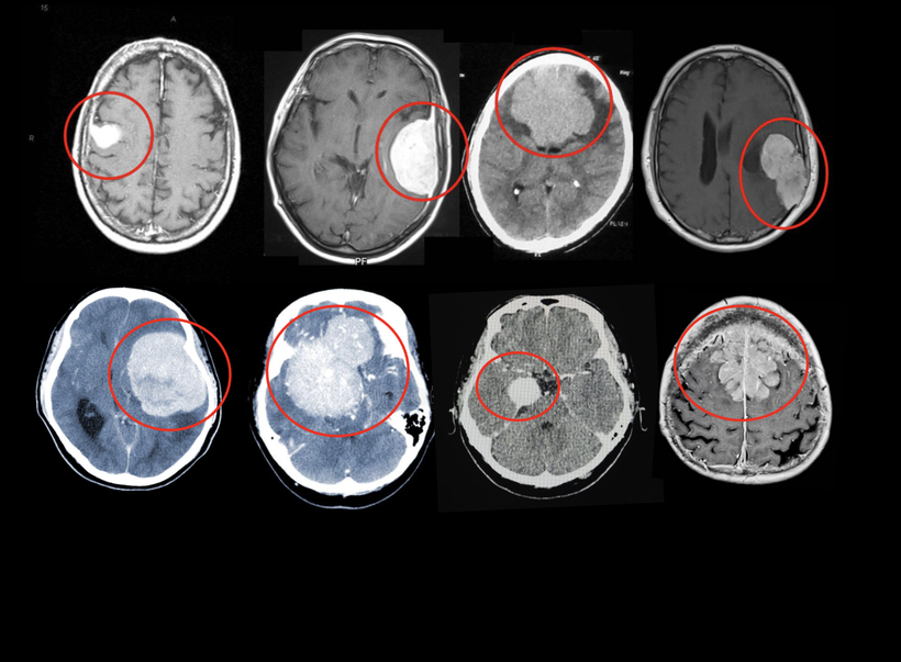 いろいろな場所にできる髄膜腫をわかりやすく理解するためのMRI、CT画像をお見せします。