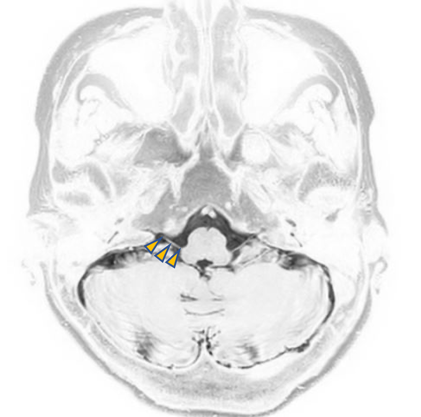 頭部MRI画像で見た舌咽神経の走行（位置）