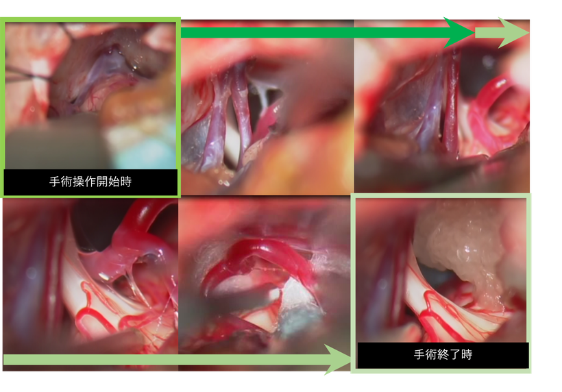 三叉神経痛の手術；手術の手順と操作を経時的にまとめた手術時の画像
