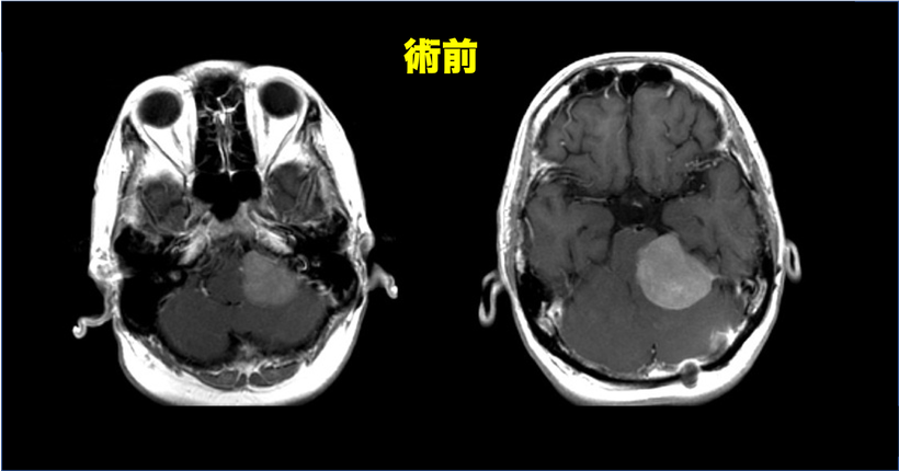 歩行障害にて車椅子で来院した後頭蓋窩髄膜腫の３６歳男性の症例　術前の頭部MRI画像