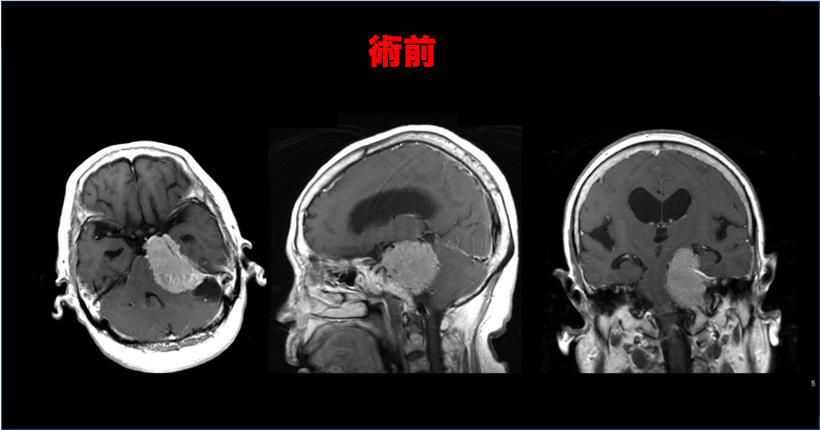 めまいと歩行障害により車椅子で来院した後頭蓋窩髄膜腫（斜台錐体部髄膜腫）；７２歳女性の症例　術前のMRI画像