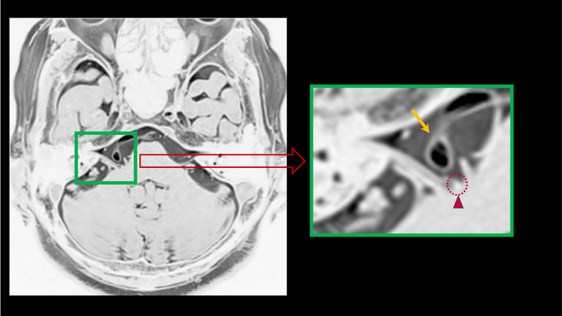 頭部MRI画像で確認できる血管による顔面神経への圧迫（拡大画像を含む）pattern３