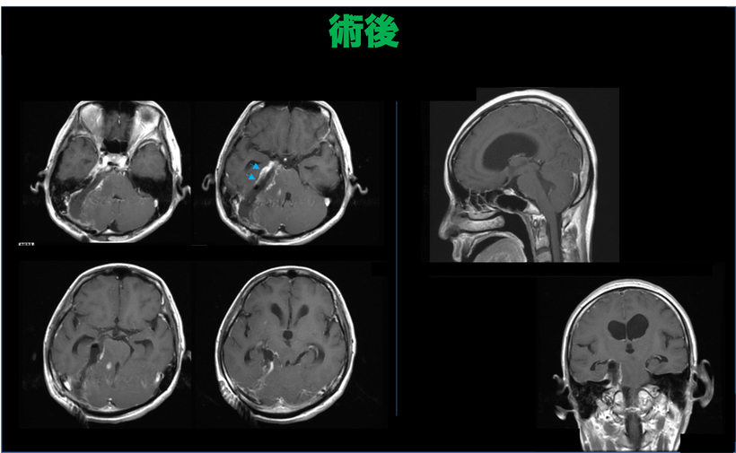 難聴にて発症した手術が難しい後頭蓋窩髄膜腫（斜台錐体部髄膜腫）；４６歳女性の症例の術後の画像