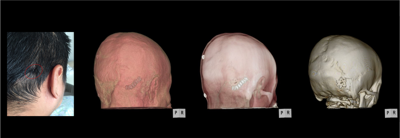 鍵穴手術の術後の３D画像（CT）