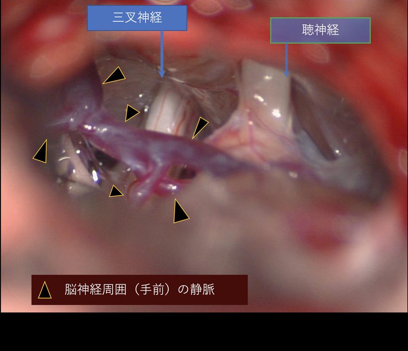 三叉神経痛の手術視野；重要な静脈の走行が確認される。損傷すると重大な脳出血を引き起こす可能性があります。