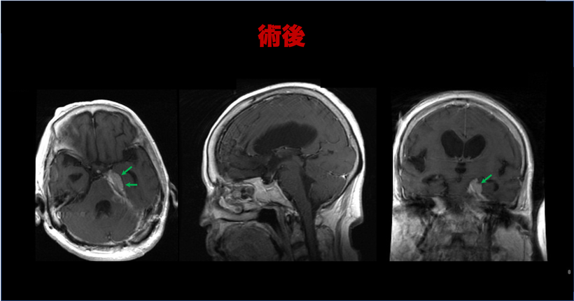 めまいと歩行障害により車椅子で来院した後頭蓋窩髄膜腫（斜台錐体部髄膜腫）；７２歳女性の症例　術後のMRI画像