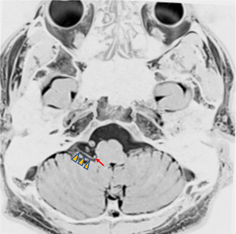 舌咽神経痛の頭部MRI画像；血管が舌咽神経を圧迫している事を示すわかりやすい画像
