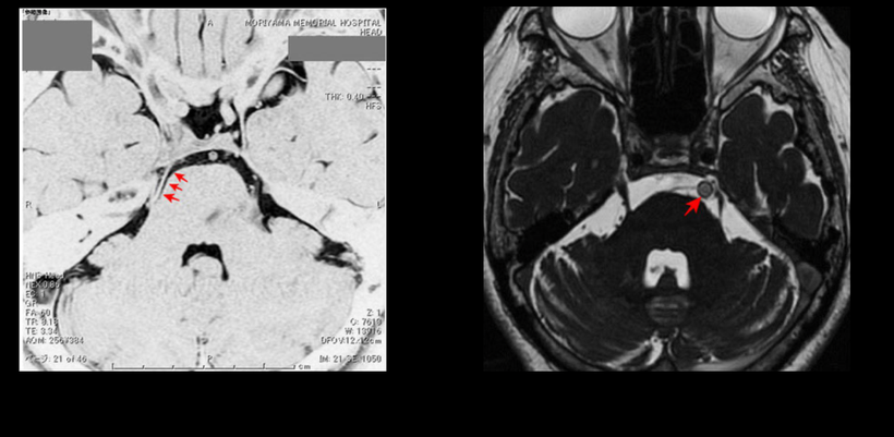 頭部MRI画像での三叉神経痛の画像所見；圧迫血管の大きさの違いが、はっきりわかるMRI画像