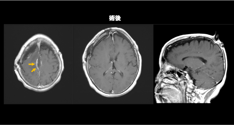 多発性髄膜腫の症例のMRI画像１の術後の画像