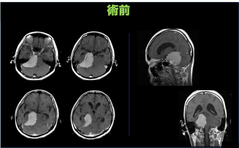 難聴にて発症した手術が難しい後頭蓋窩髄膜腫（斜台錐体部髄膜腫）の４６歳女性の症例　術前の頭部MRI画像