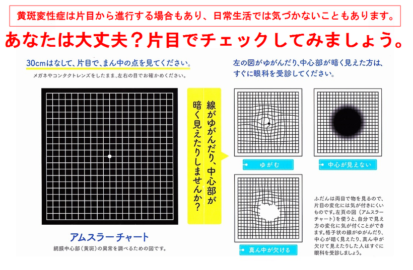 加齢黄斑変性症を、アムスラーチャートでチェックする方法。あなたは大丈夫？片目でチェックしてみましょう。