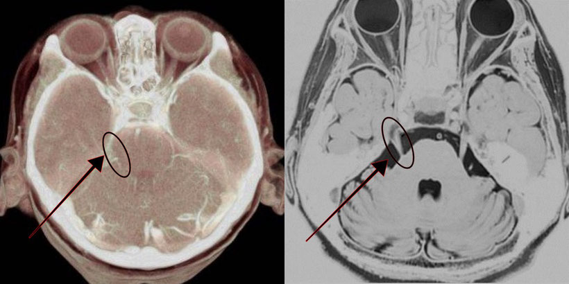 頭部MRI画像検査で三叉神経の位置をわかりやすく説明する画像＃１