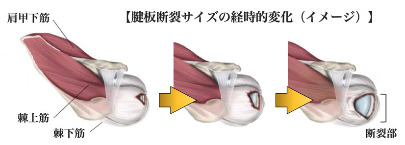 腱板断裂サイズの拡大、低侵襲、関節鏡視下腱板修復術、手術、名戸ヶ谷病院、関節治療センター、國府幸洋、整形外科、千葉県、柏市